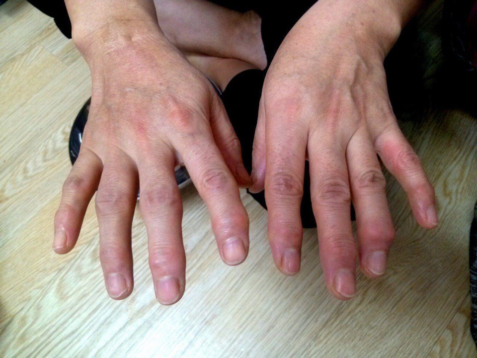 한 급식실 노동자의 손가락 관절. ⓒ 서비스연맹 학비노조 제공